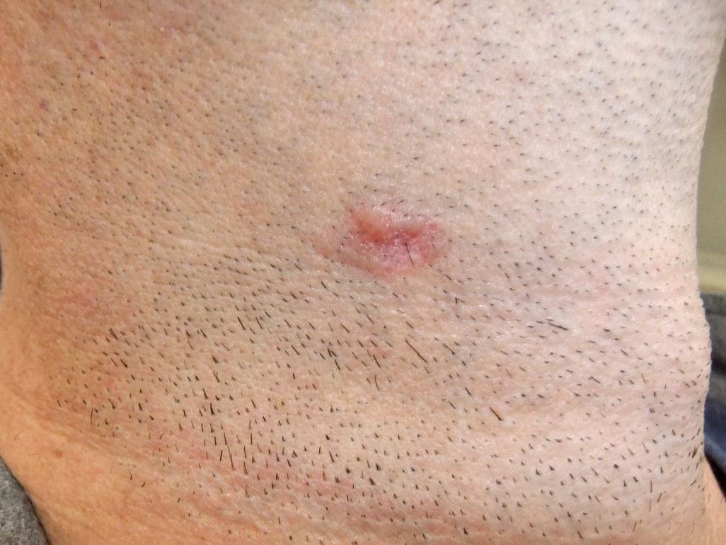 Figure 4 B, Infiltrating and micronodular basal cell carcinoma (BCC)